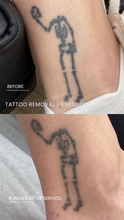 Load image into Gallery viewer, July Special - Laser Tattoo Removal (3)