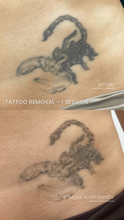 Load image into Gallery viewer, July Special - Laser Tattoo Removal (3)
