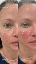 Load image into Gallery viewer, June Special - PRP Treatments