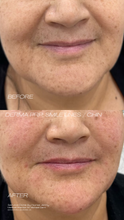 Load image into Gallery viewer, June Special - PRP Treatments
