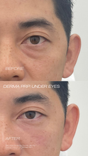 Load image into Gallery viewer, June Special - PRP Treatments