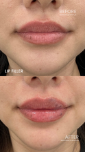 Load image into Gallery viewer, July Special - Lip Filler