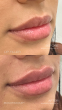 Load image into Gallery viewer, July Special - Lip Filler