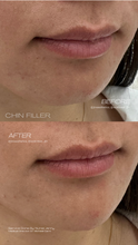 Load image into Gallery viewer, July Special - Lip Filler