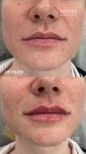 Load image into Gallery viewer, July Special - Lip Filler