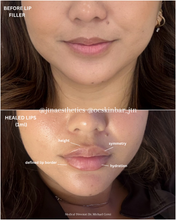 Load image into Gallery viewer, July Special - Lip Filler