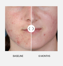 Load image into Gallery viewer, ZO® Skin Health Acne Control