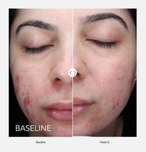 Load image into Gallery viewer, ZO® Skin Health Retinol + Acne Complex