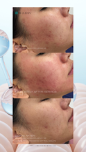 Load image into Gallery viewer, Microneedling W/ Rejuran Special (3) for $1299
