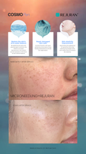 Load image into Gallery viewer, Microneedling W/ Rejuran Special (3) for $1299
