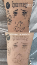 Load image into Gallery viewer, July Special - Laser Tattoo Removal (3)
