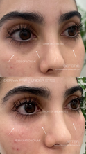 Load image into Gallery viewer, June Special - PRP Treatments
