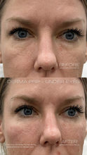 Load image into Gallery viewer, June Special - PRP Treatments
