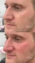 Load image into Gallery viewer, June Special - PRP Treatments
