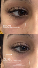 Load image into Gallery viewer, June Special - PRP Treatments
