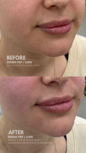 Load image into Gallery viewer, June Special - PRP Treatments

