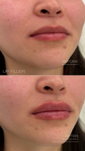 Load image into Gallery viewer, July Special - Lip Filler
