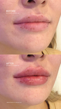 VDAY SPECIAL - Cupid's Touch ($450 Lip FIller)