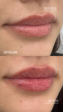 Load image into Gallery viewer, July Special - Lip Filler
