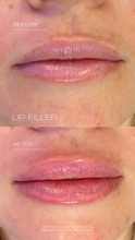 VDAY SPECIAL - Cupid's Touch ($450 Lip FIller)