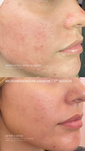 Load image into Gallery viewer, July Special - Microneedling with Rejuran (3)
