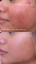 Load image into Gallery viewer, July Special - Microneedling with Rejuran (3)
