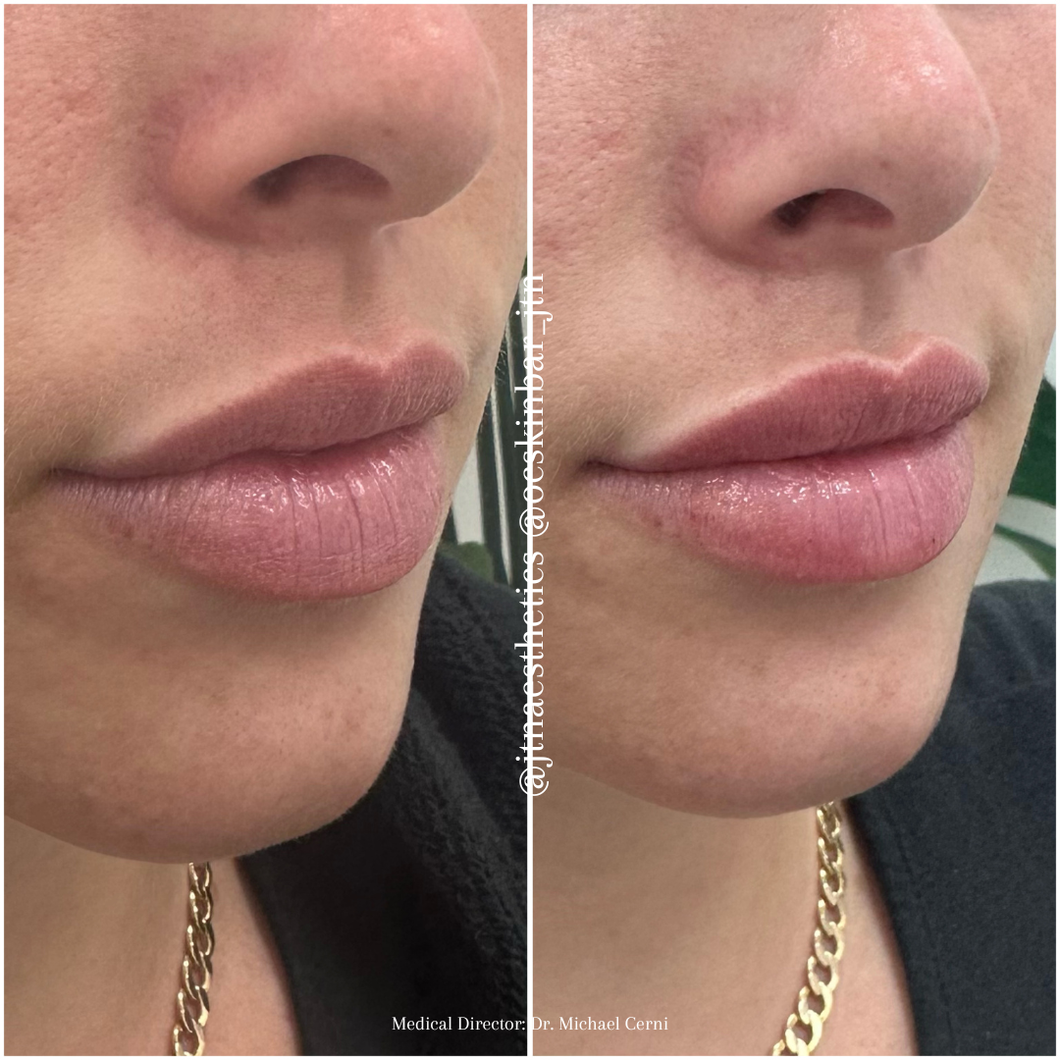 Black Friday Specials - Injectables