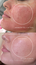 Load image into Gallery viewer, Microneedling W/ Rejuran Special (3) for $1299
